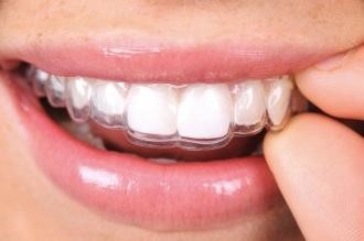 Advantages of Clear Aligners – US Dental