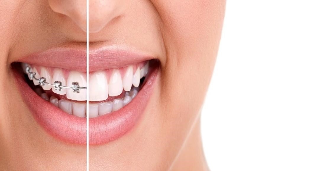 Clear Aligners Treatment in Ahmedabad– US Dental