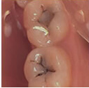 Dental cavities/decayed teeth