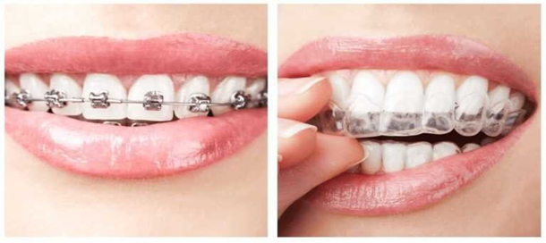 Invisalign Clear Aligner Clinic in Ahmedabad India – Teeth Care