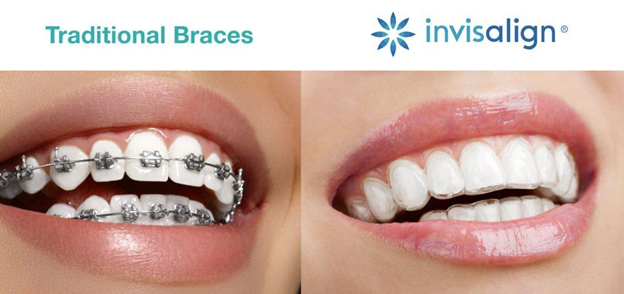 Invisalign Invisible Braces - Best Clear Invisible Aligners