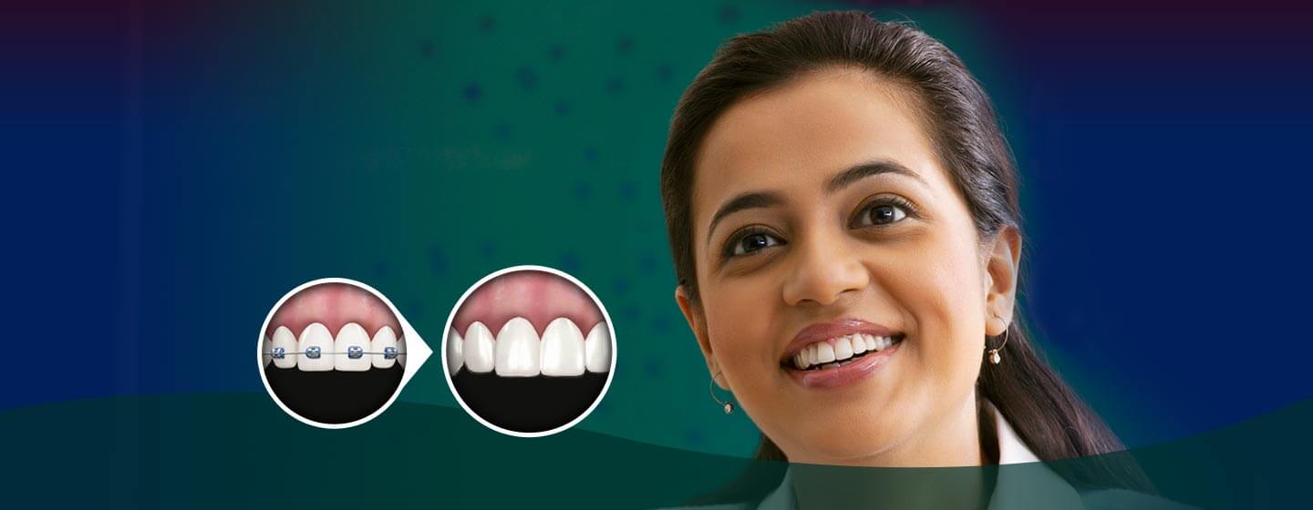 Clear Aligner Treatment Ahmedabad India, Original Results Full Gallery