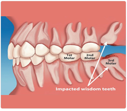 non impacted wisdom teeth